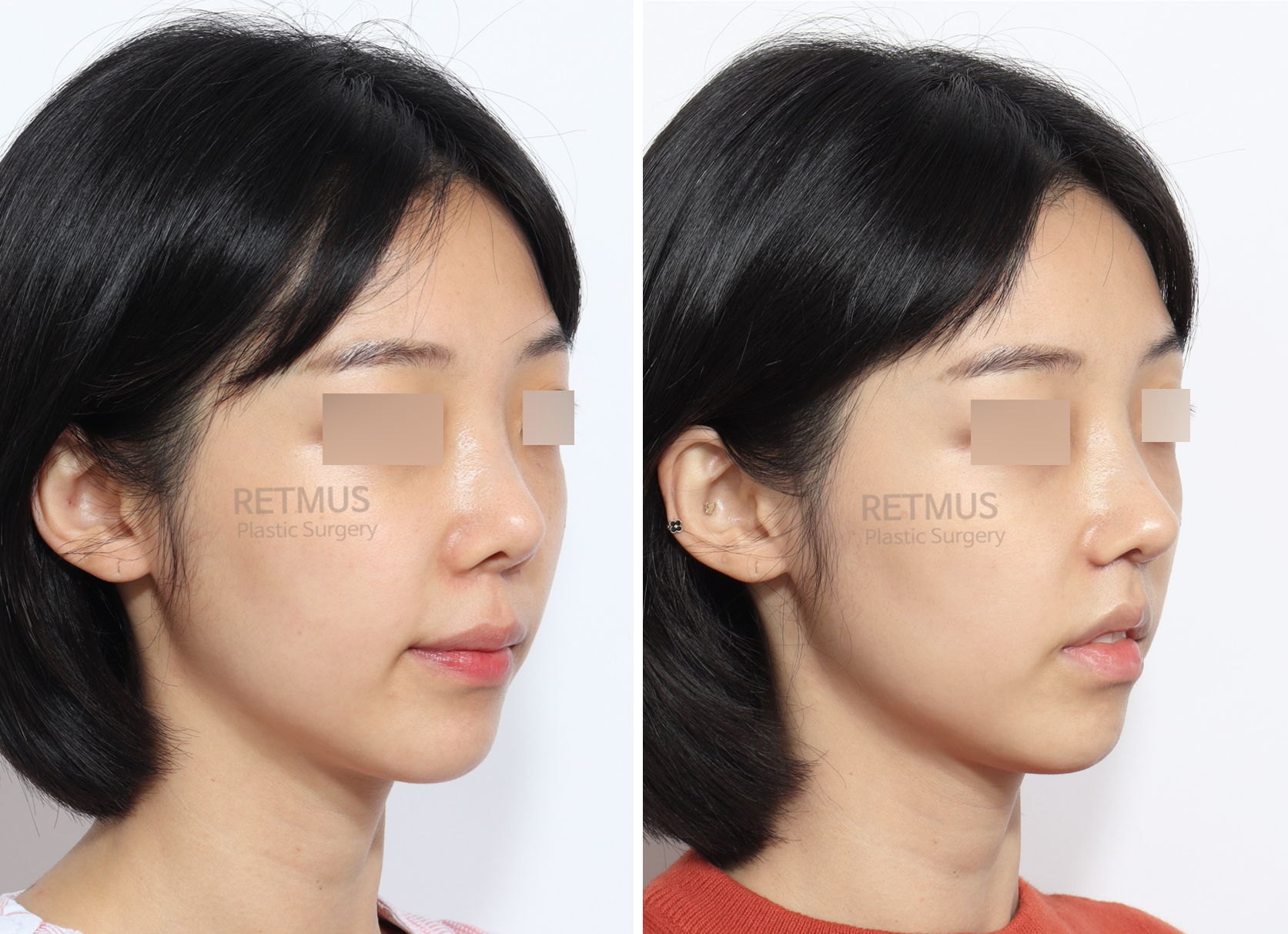인중코 1개월차[인중축소+코끝재수술] (upper lip lift + tip revision)