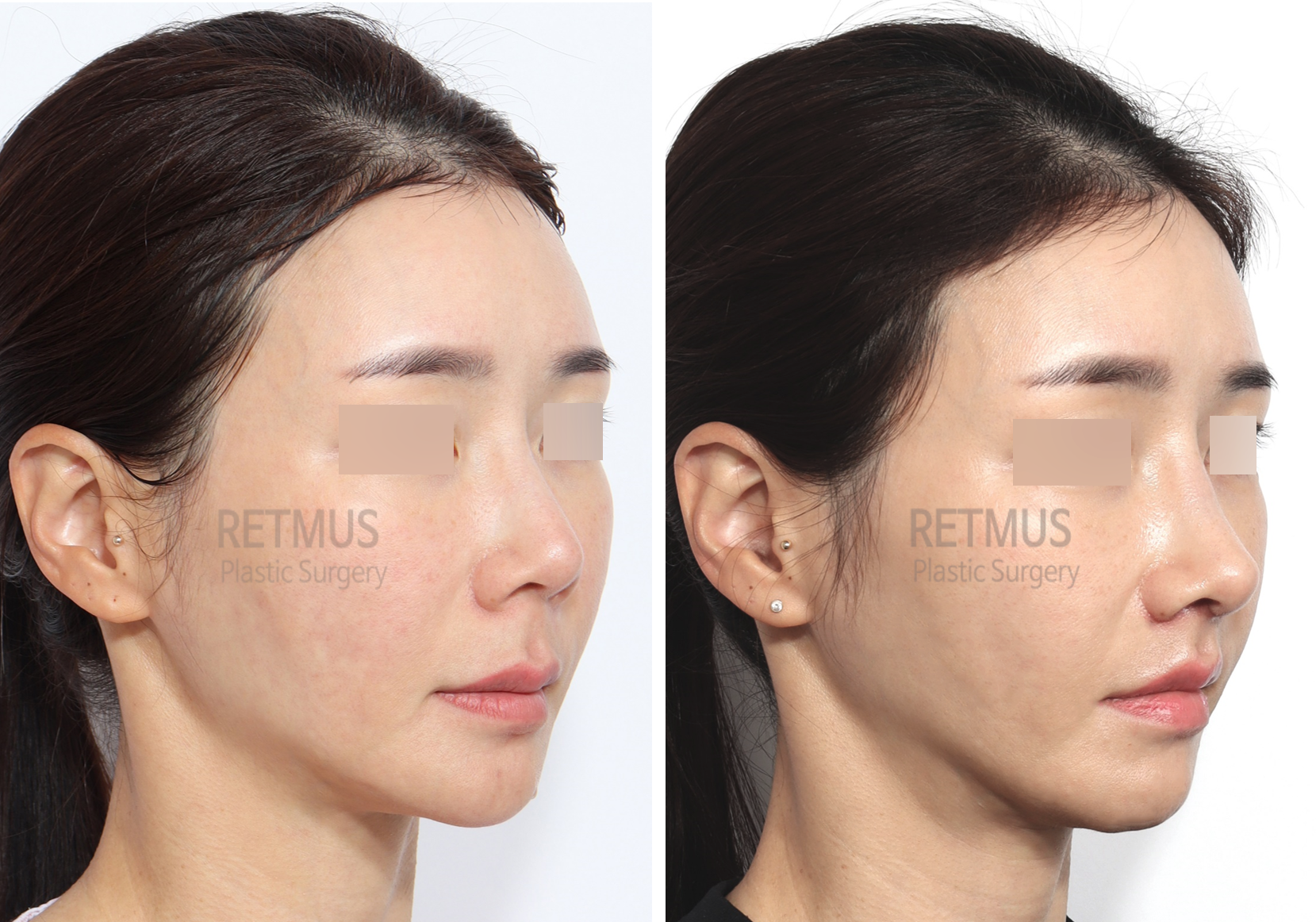 인중코 1개월차 [인중축소+코끝재수술] (upper lip lift+ tip revision)