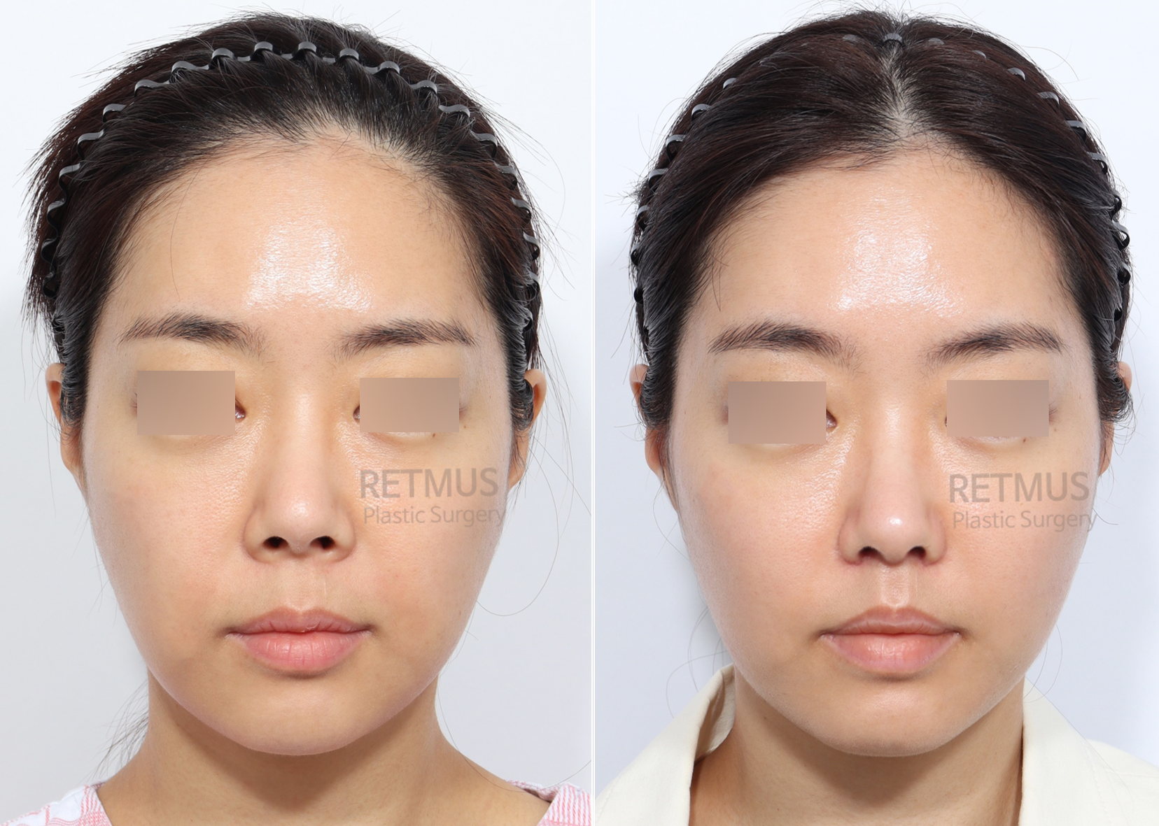 인중코 2개월차 [인중축소+코끝재수술] (upper lip lift+ tip revision)