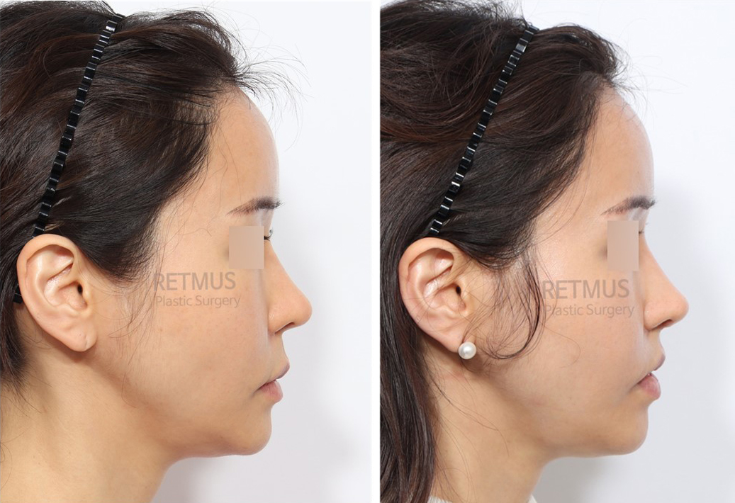 인중코 1주차 [인중축소+코끝재수술] (upper lip lift+ tip revision)