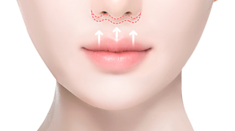 리트머스성형외과 기존 인중축소 절개방식 첫번째 이미지