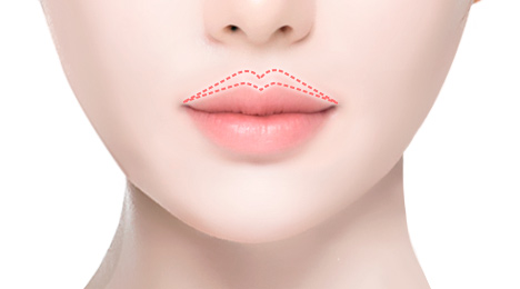 리트머스성형외과 기존 인중축소 절개방식 두번째 이미지