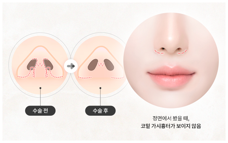 리트머스성형외과 인중축소의 특별함 설명 이미지