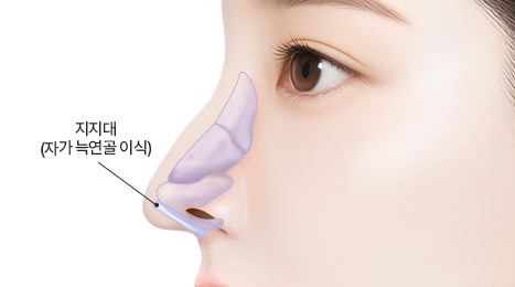 리트머스 화살코 수술방법 이미지