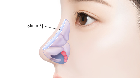 리트머스 자가진피 수술방법 이미지