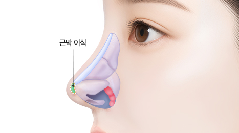 리트머스 자가근막 수술방법 이미지