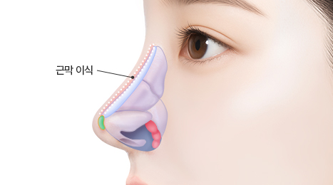 리트머스 자가근막 수술방법 이미지