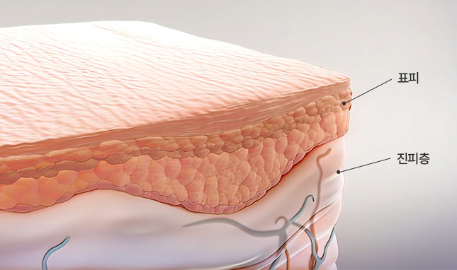 리트머스성형외과 자가조직코재수술 이미지