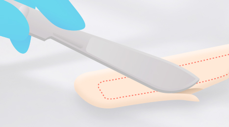 리트머스 성형외과 자가연골 수술방법 이미지
