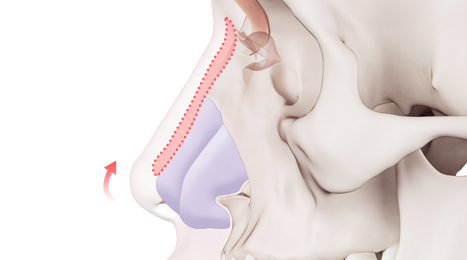 리트머스 성형외과 자가연골 수술방법 이미지