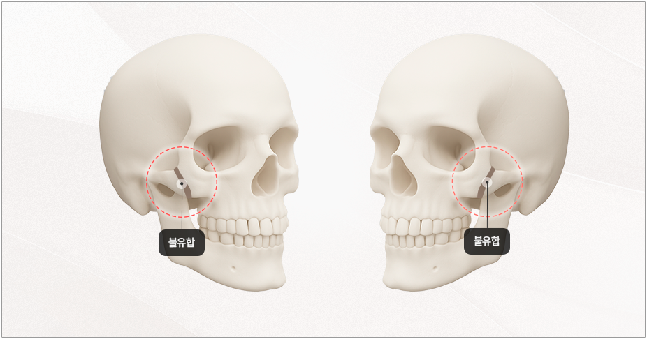 리트머스성형외과 광대수술 핵심 이미지