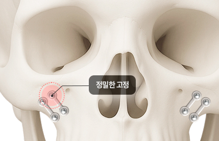 리트머스성형외과 차별화포인트 첫번째 이미지