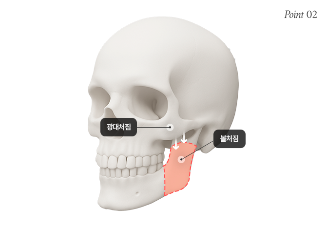 리트머스성형외과 광대뼈 단단하게 고정해야하는 이유 이미지