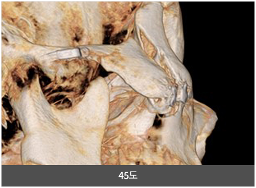 리트머스성형외과 회전 리프팅 광대 축소술 두개골 45도 왼쪽 이미지
