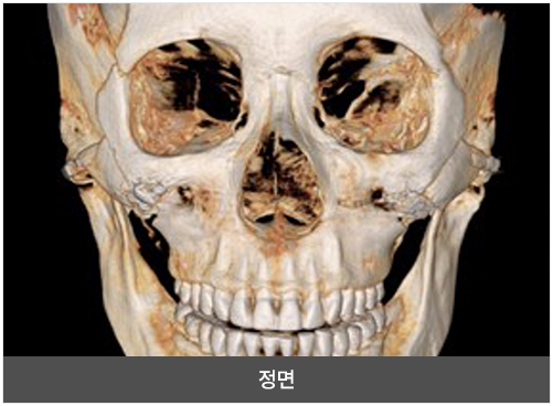 리트머스성형외과 회전 리프팅 광대 축소술 두개골 정면 이미지