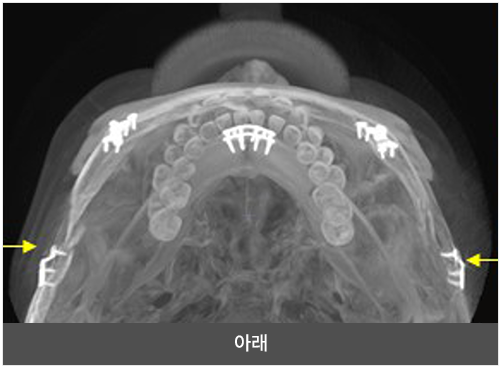 리트머스성형외과 회전 리프팅 광대 축소술 두개골 45도 오른쪽 이미지