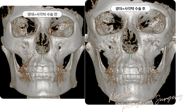 리트머스성형외과 안면윤곽 ct수술 전후사진 이미지