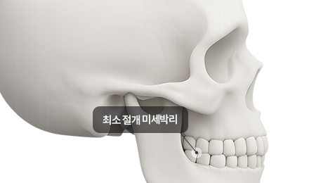 리트머스성형외과 수술방법 이미지