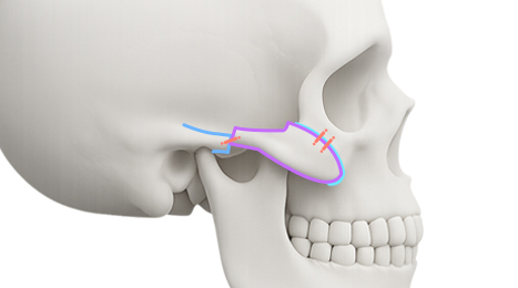 리트머스성형외과 수술방법 이미지