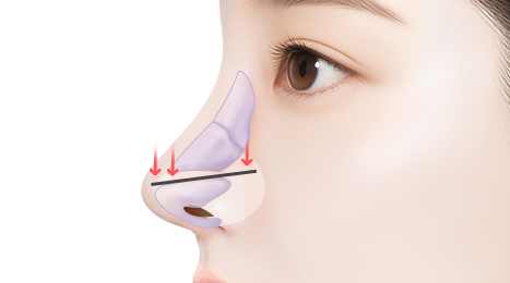 리트머스 용코/찝힌코 수술방법 이미지
