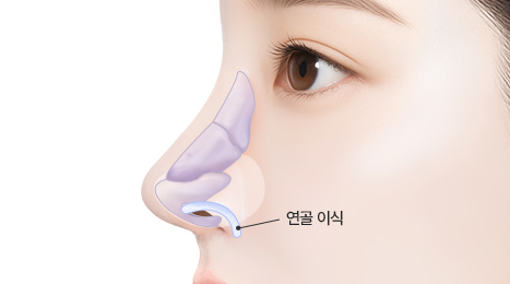 리트머스 용코/찝힌코 수술방법 이미지