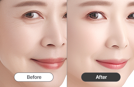 리트머스성형외과 필러 포인트 이미지