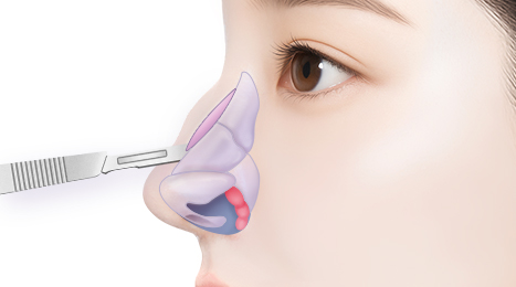 리트머스 매부리코 수술방법 이미지