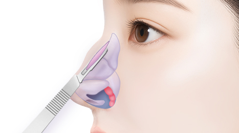 리트머스 매부리코 수술방법 이미지