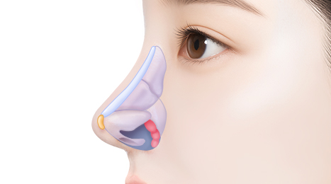 리트머스 매부리코 수술방법 이미지