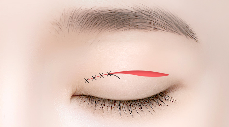 리트머스성형외과 수술방법 이미지