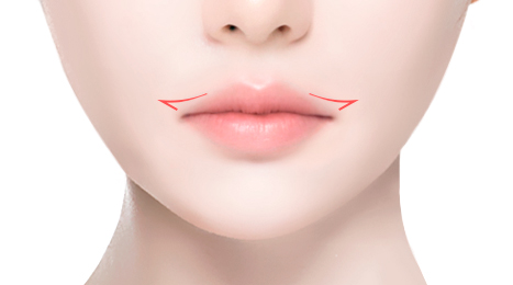 리트머스 외측입꼬리 수술방법 이미지