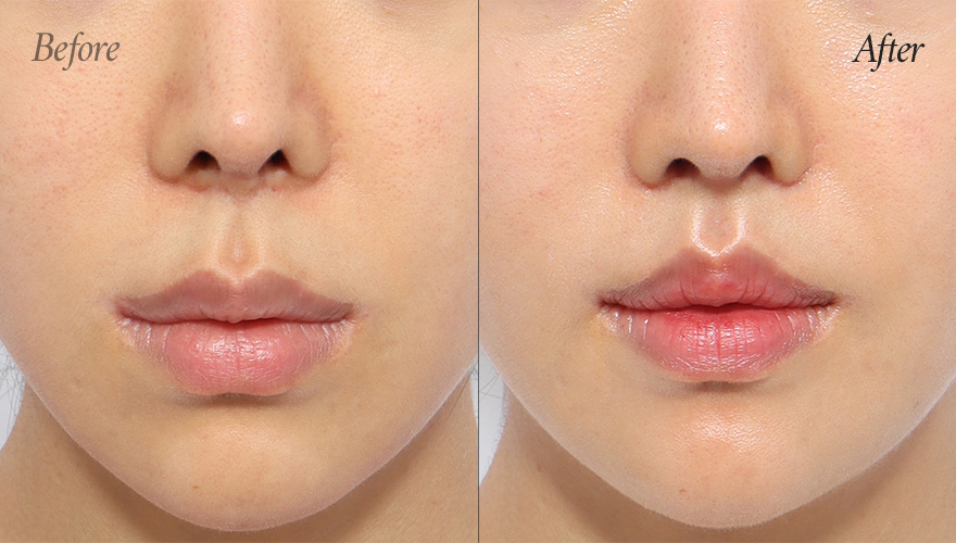 리트머스성형외과 인중축소재수술 전후사진 이미지