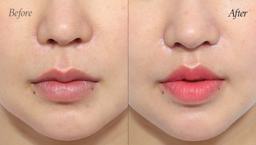 리트머스성형외과 인중축소재수술 전후사진 이미지