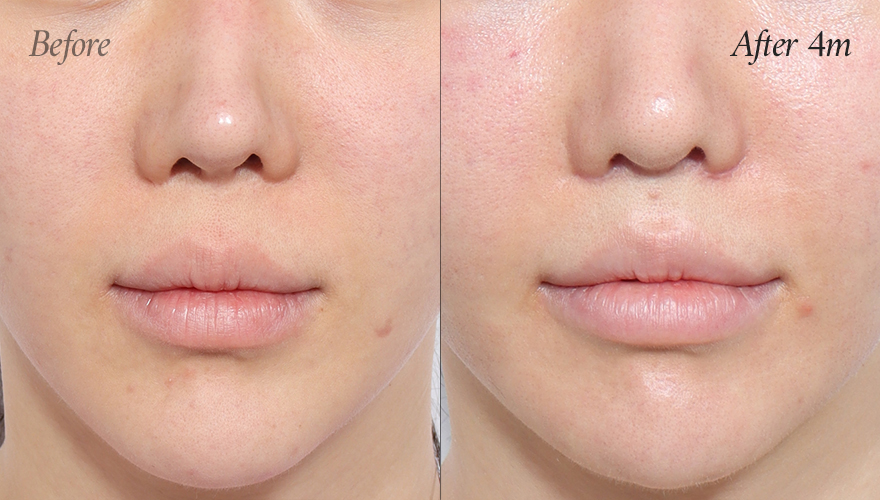 리트머스성형외과 인중축소재수술 전후사진 이미지