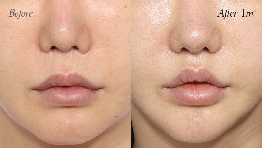 리트머스성형외과 인중축소재수술 전후사진 이미지