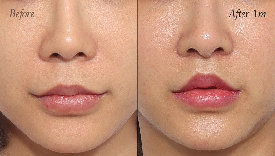 리트머스성형외과 인중축소재수술 전후사진 이미지