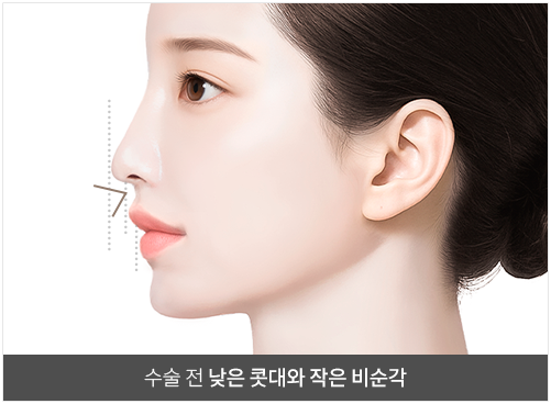 리트머스성형외과 인중코 비순각 수술 이미지