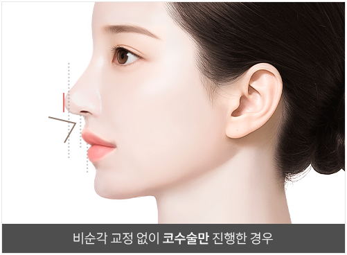리트머스성형외과 인중코 비순각 수술 이미지