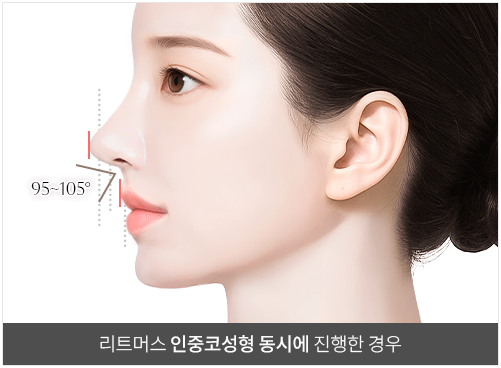리트머스성형외과 인중코 비순각 수술 이미지