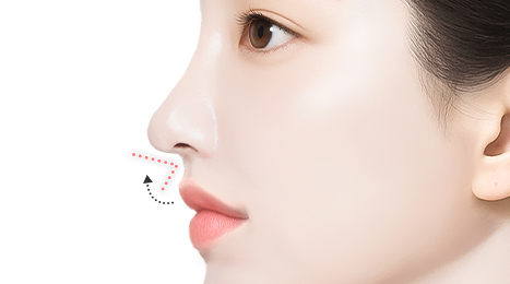 리트머스 인중코,인중코끝 수술방법 이미지