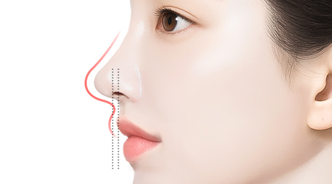 리트머스 인중코,인중코끝 수술방법 이미지