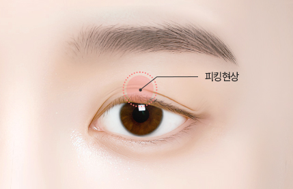 리트머스성형외과 차별화포인트 세번째 이미지