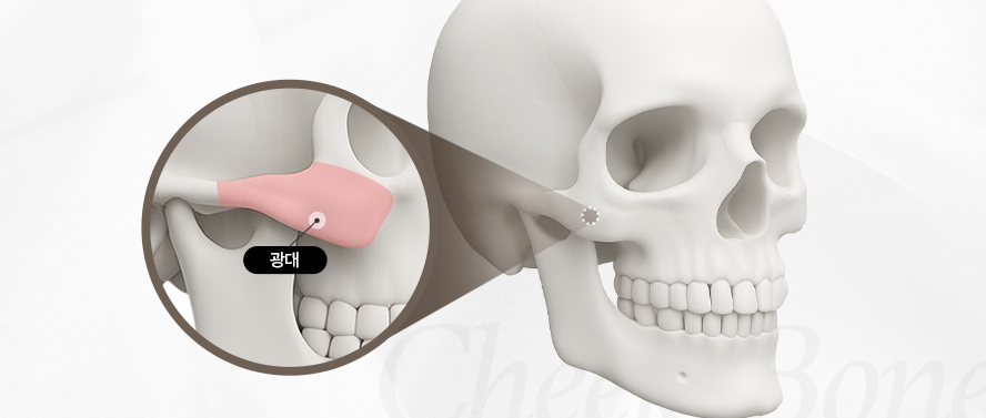 리트머스성형외과 안면윤곽 재수술 종류 이미지