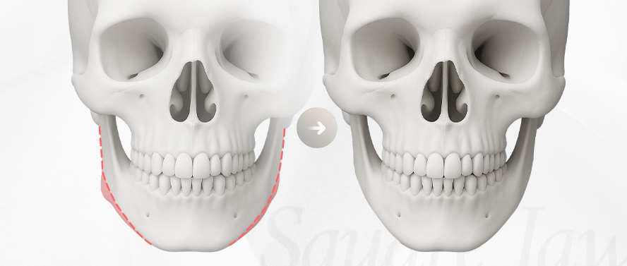 리트머스성형외과 안면윤곽 재수술 종류 이미지
