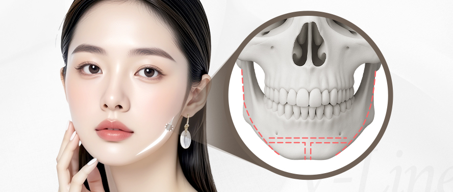 리트머스성형외과 안면윤곽 재수술 종류 이미지