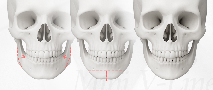 리트머스성형외과 안면윤곽 재수술 종류 이미지