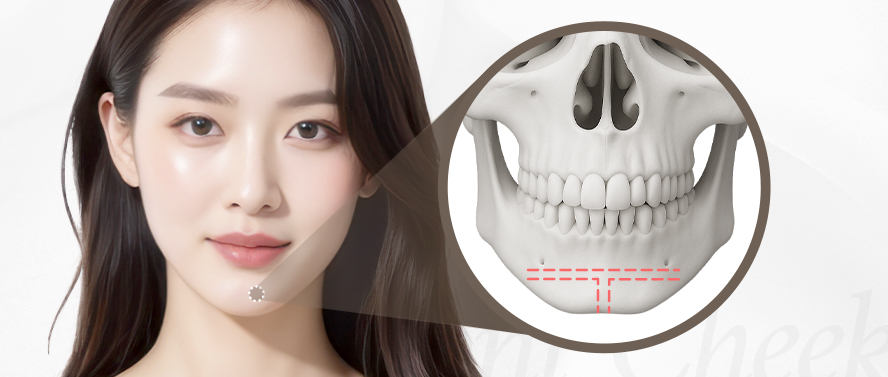 리트머스성형외과 안면윤곽 재수술 종류 이미지