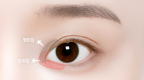 리트머스성형외과 수술방법 이미지