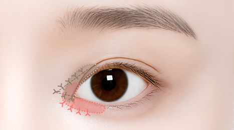 리트머스성형외과 수술방법 이미지