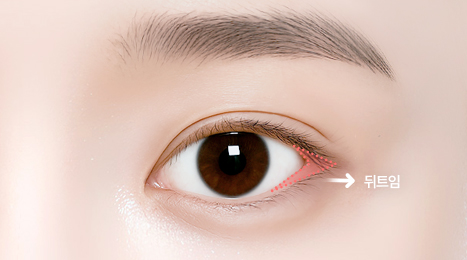 리트머스성형외과 수술방법 이미지